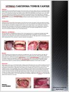پوستر Poster Presentaton About Scomas Carcinoma Tongue Cancer